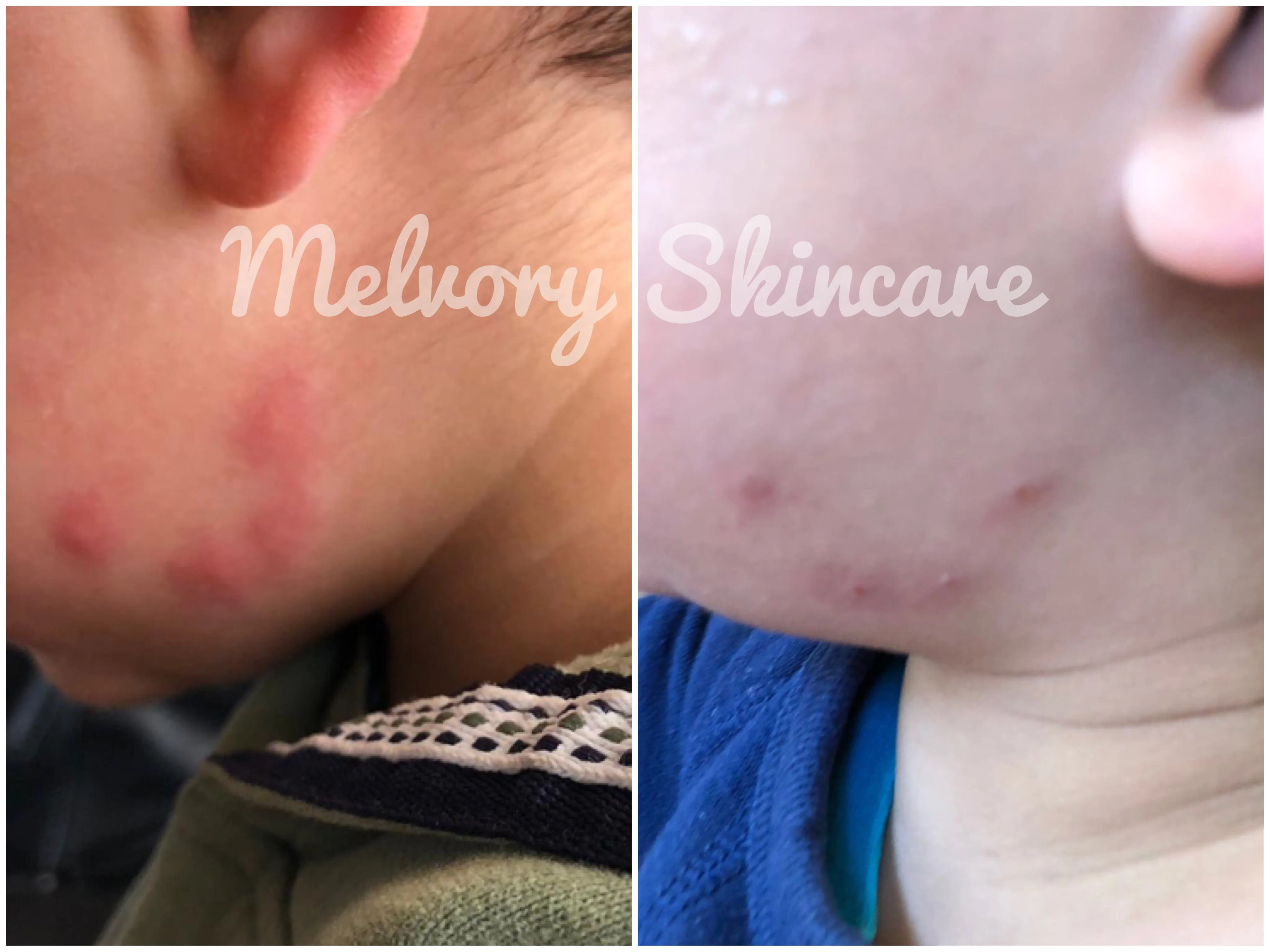 Mozzie Balm